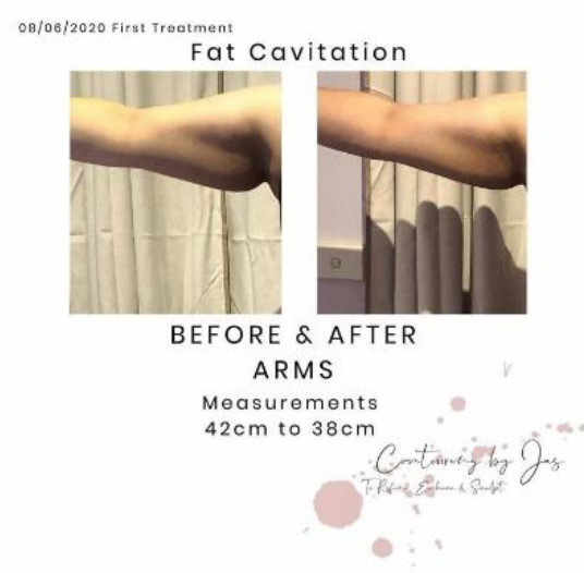 fat caviation 3 - Cure Newsletter July 2020