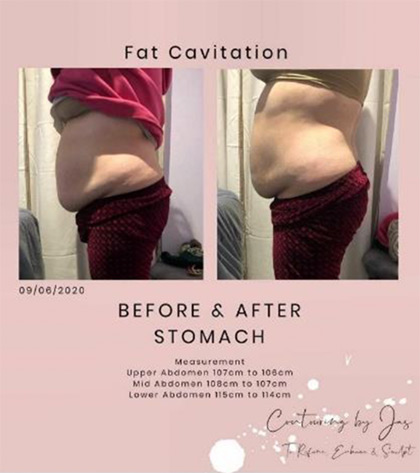 fat caviation - Cure Newsletter July 2020